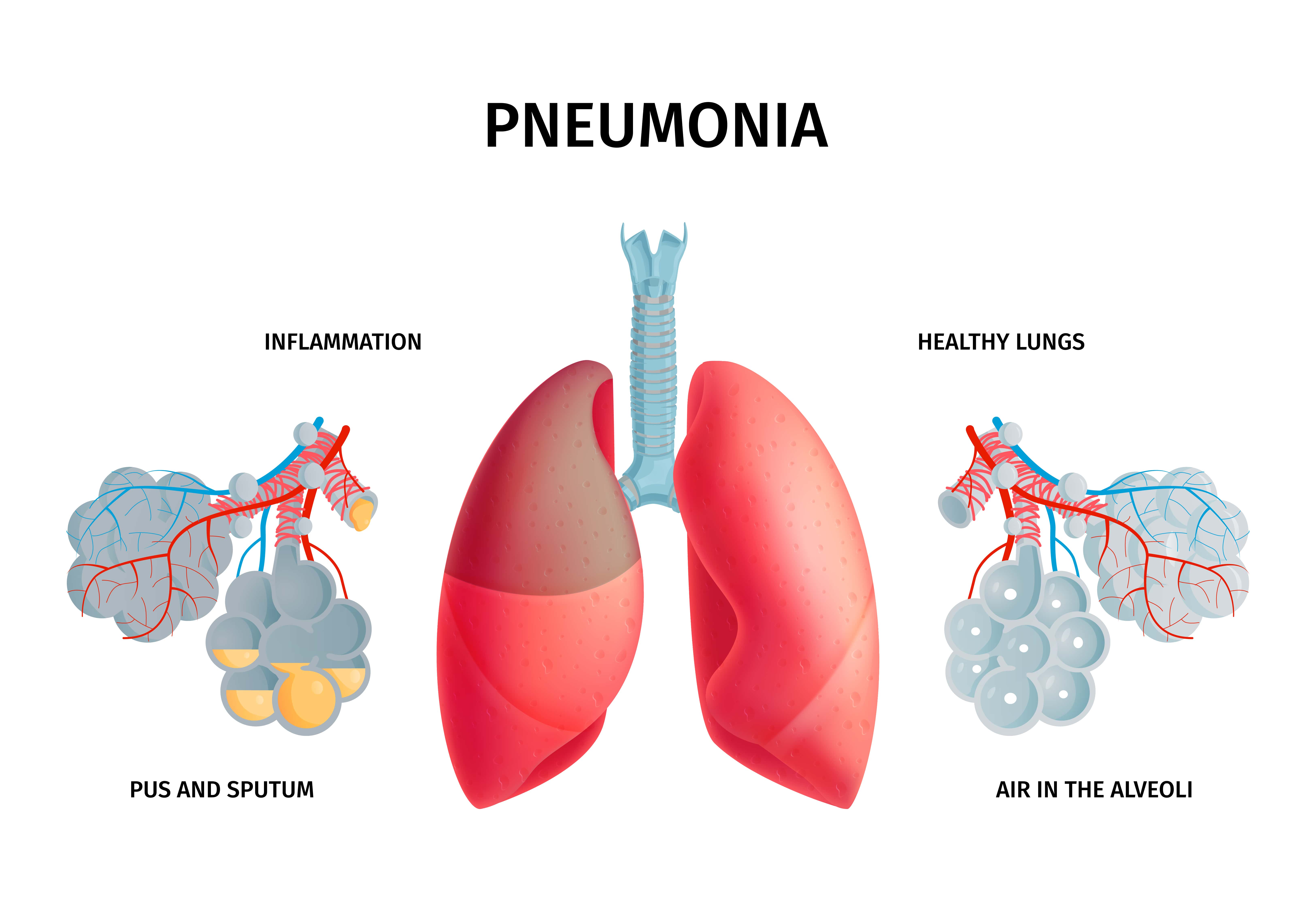Pneumonia A Common Winter Illness – Your Guide to Staying Healthy